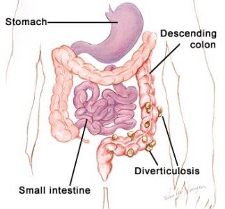 Ocluzie intestinala